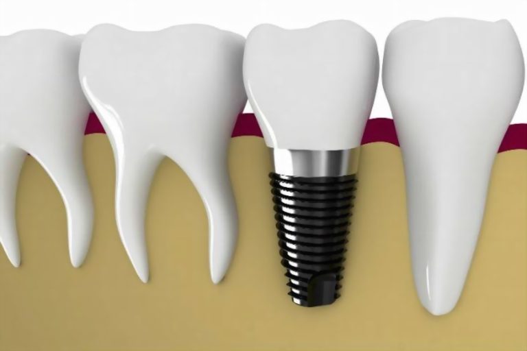 Dental implants in Bodrum