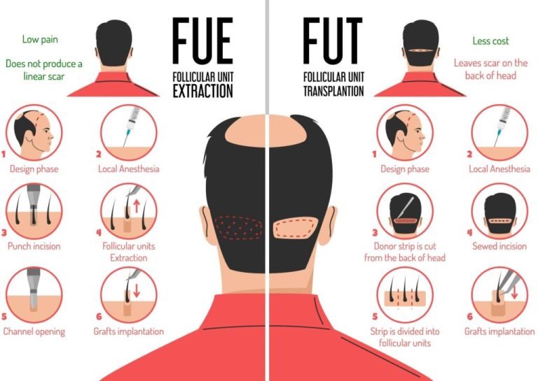 FUE Hair Transplant Method (Follicular Unit Extraction)